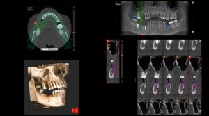 Digitale Planung einer Zahnimplantation