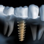 Mythen ueber Implantate