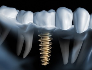 Mythen ueber Implantate Mythen ueber Implantate