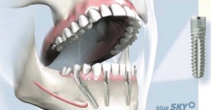 Durch das Fast- & Fixed-Verfahren können feste Zähne an einem Tag ermöglicht werden. 