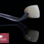 Veneers sind hauchdünne Keramikschälchen, die auf den Zahn aufgesetzt werden
