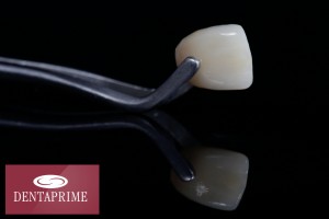 Veneers sind hauchdünne Keramikschälchen, die auf den Zahn aufgesetzt werden