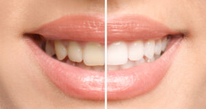 Veneers to Go