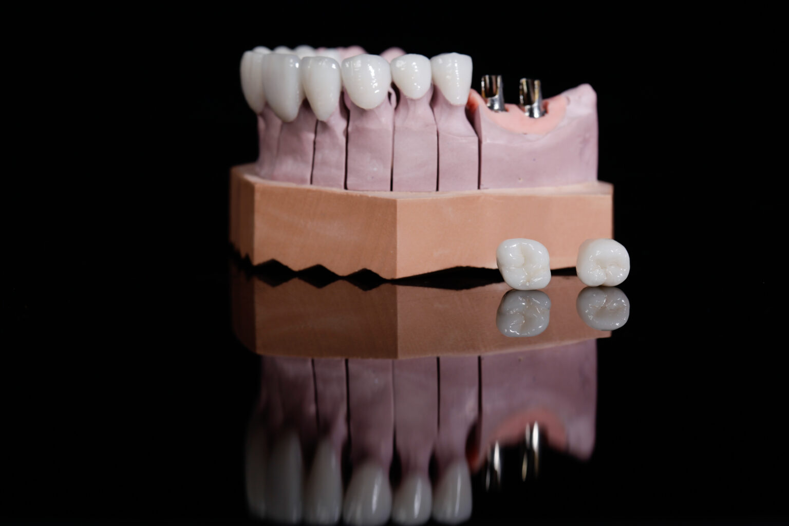 Krone oder Veneers Was ist besser? Ein Vergleich
